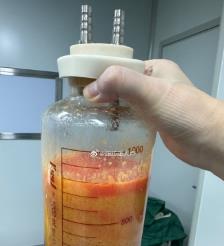 开平水动力吸脂手术要做多久？
